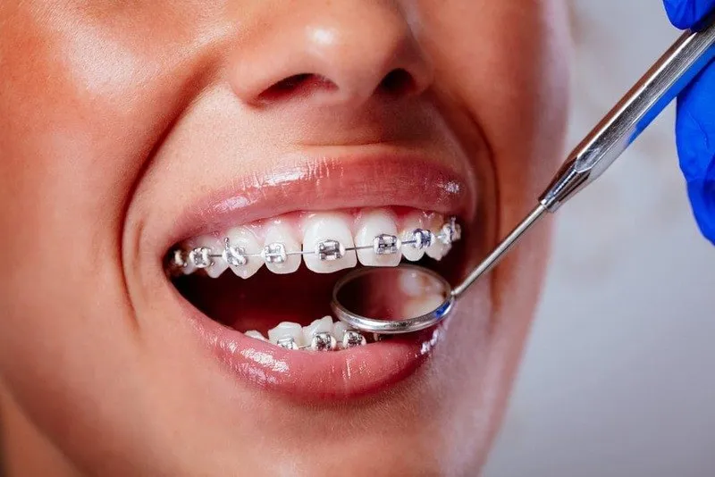 Các giai đoạn niềng răng - Sắp xếp đều răng trên hàm