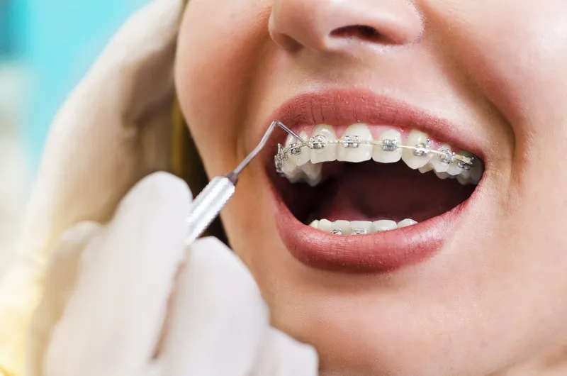 Giai đoạn niềng răng - Duy trì ổn định