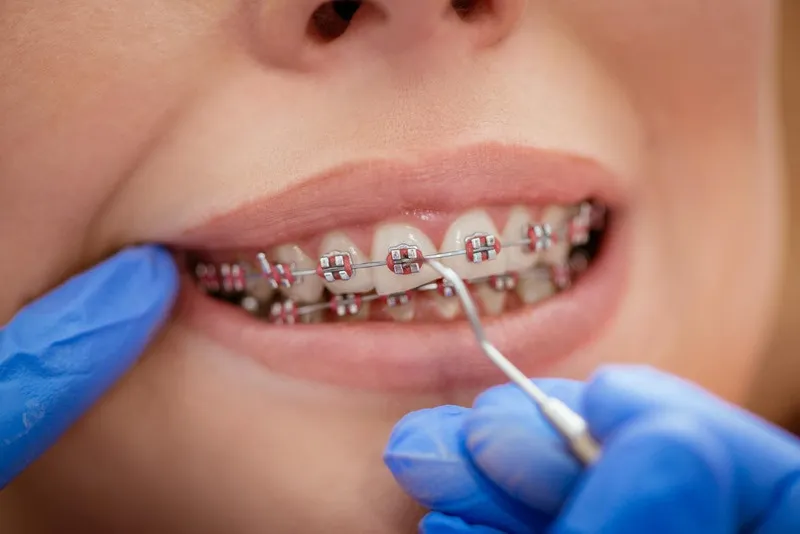 Cách rút ngắn thời gian niềng răng
