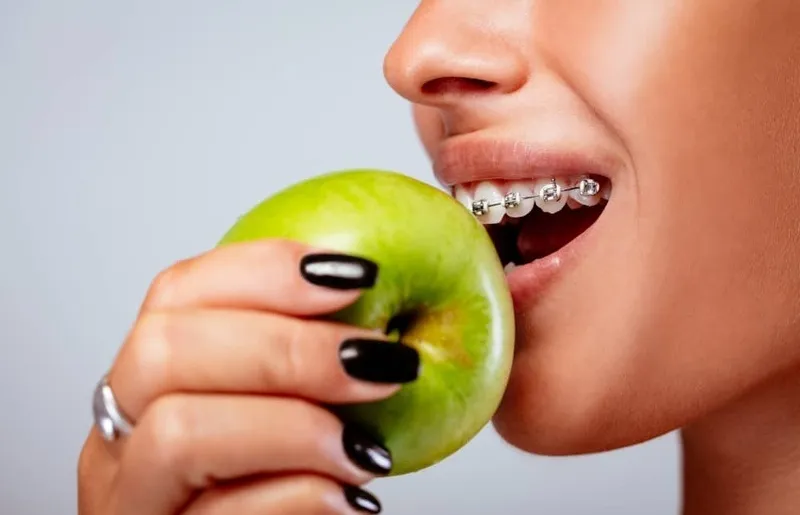 Niềng răng bao lâu thì được ăn đồ cứng