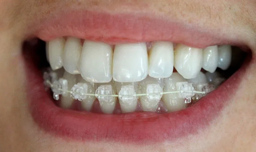 Kết quả niềng răng sau 1 tháng - Các giai đoạn cụ thể - 2