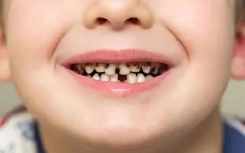Răng bé bị mảng bám vàng là tình trạng gì?