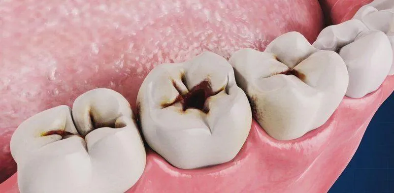 Các biến chứng thường gặp khi răng sâu vào tủy