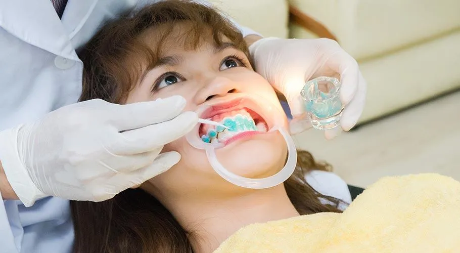 Cách tẩy trắng răng bị ố vàng lâu năm tại nha khoa