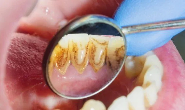 Nhận biết cao răng lâu năm như thế nào?