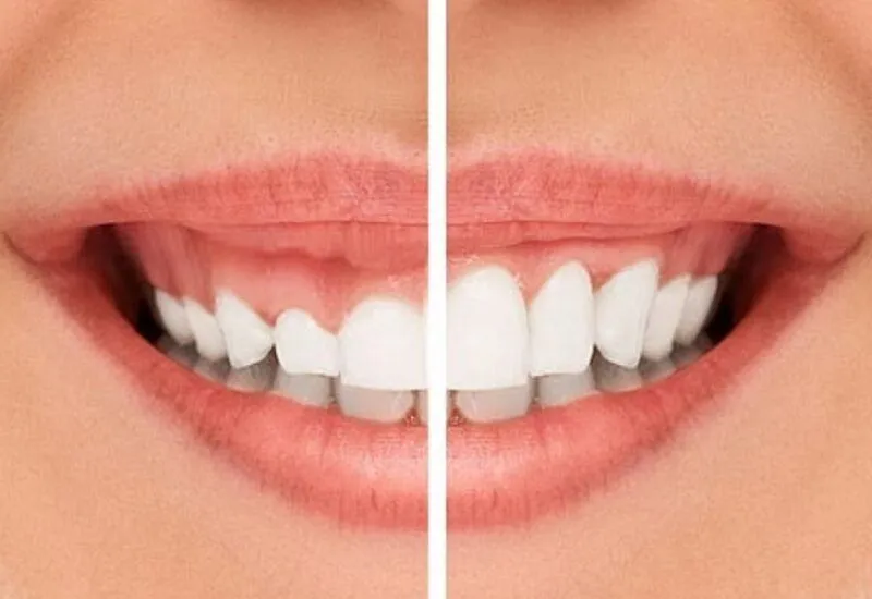 Cắt lợi là gì?