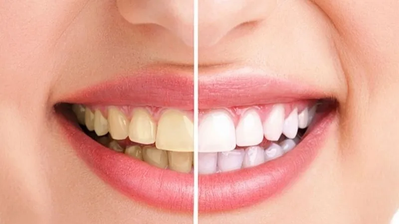 Tác hại của cao răng