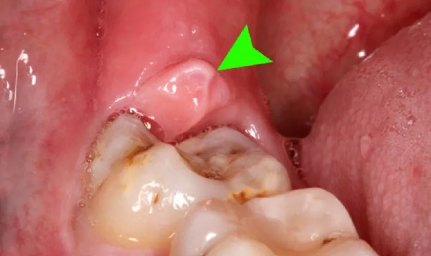 Viêm nướu răng là gì?