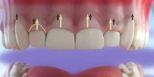 Cắt lợi là gì?