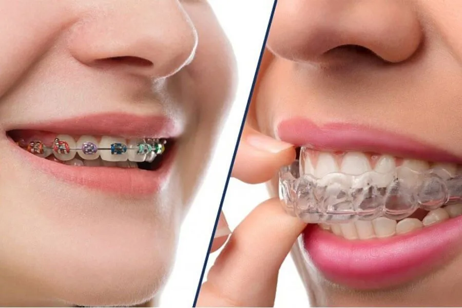 Chỉnh nha là gì?