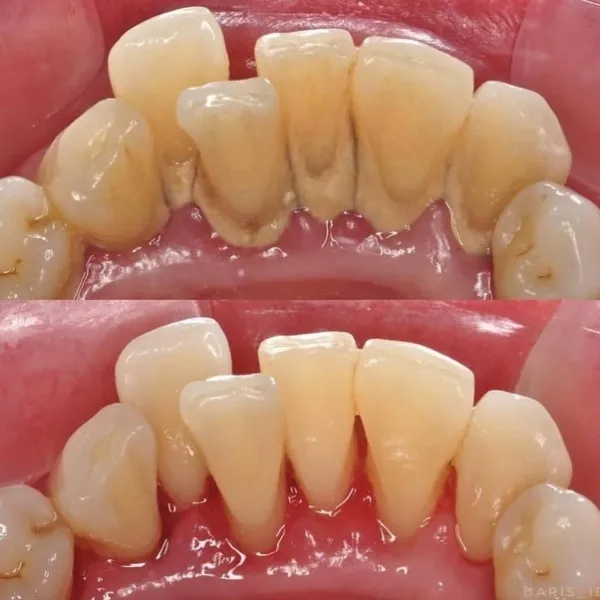 Giai đoạn 4: Răng và ổ xương răng bị phá hủy