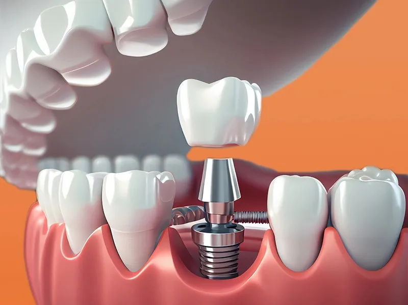 Trồng răng implant cho người bị mất răng