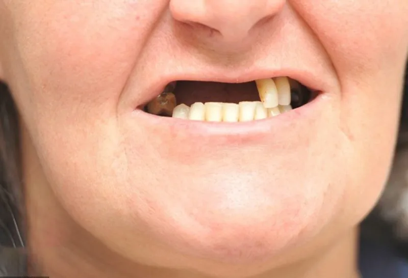 Nguyên nhân dẫn đến tình trạng mất răng