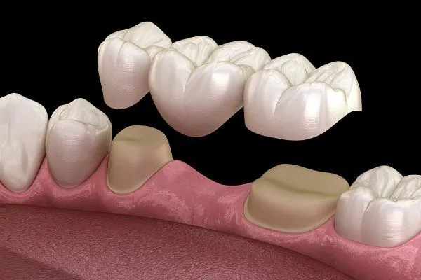Dịch vụ làm răng qua cấy ghép implant