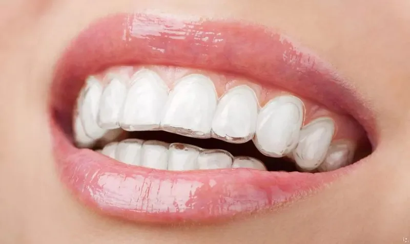 Các dịch vụ niềng răng tại Quảng Ninh