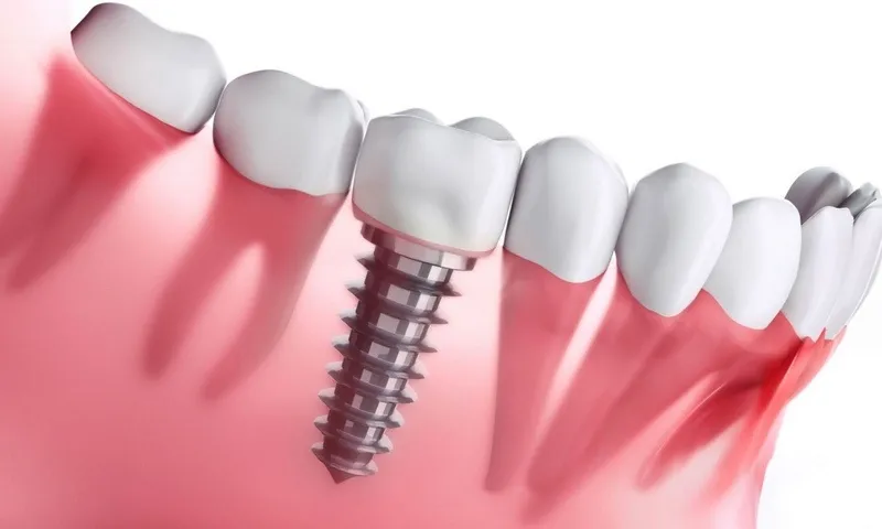 Quy trình cấy implant