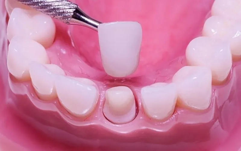 Quy trình làm răng implant - Gắn răng tạm thời