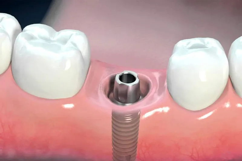 Lưu ý trong suốt các giai đoạn trồng răng implant