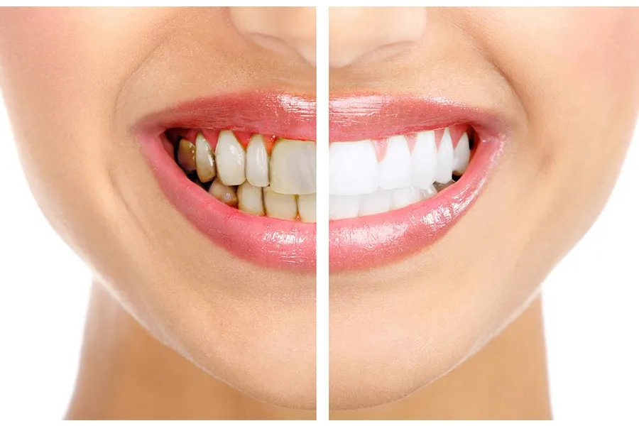 Tẩy trắng răng có làm răng yếu đi không?