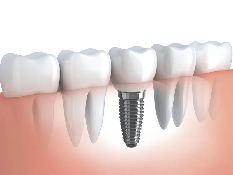 Tại sao răng implant có tuổi thọ cao