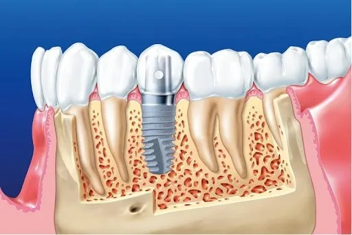 Tình trạng răng miệng và chất lượng xương hàm