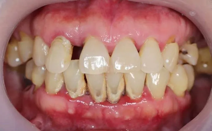 Giai đoạn 2: Bắt đầu viêm nhiễm