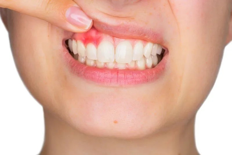 Viêm lợi trùm là gì?