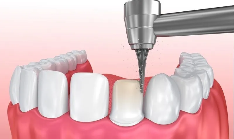 Một số lưu ý sau khi đi mài đều răng