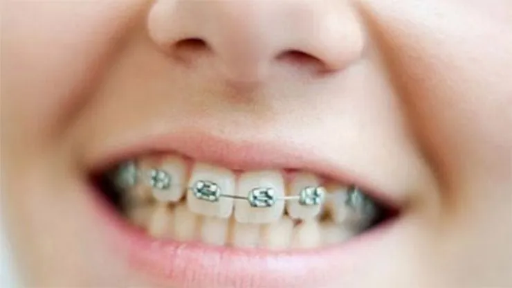Khí cụ chỉnh nha là gì?