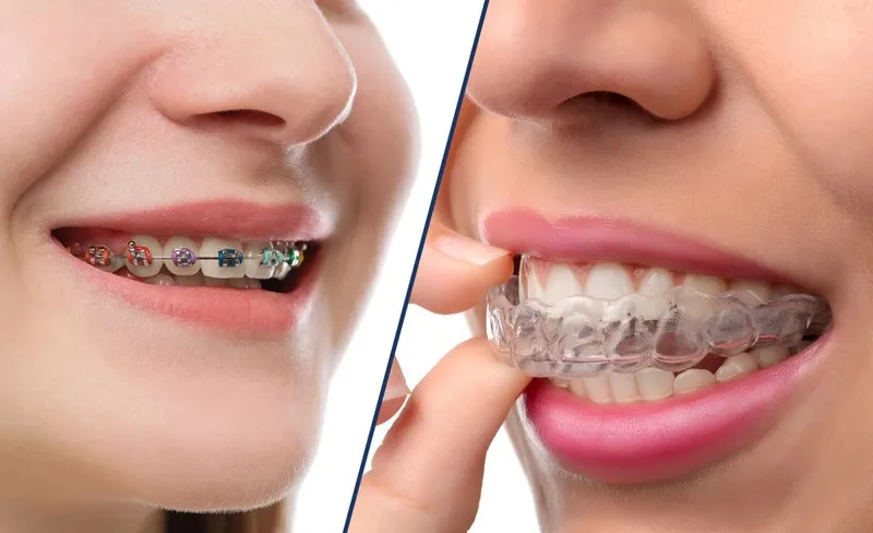 Các tiêu chí chọn dịch vụ niềng răng uy tín tại Cẩm Phả