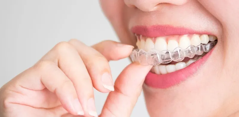 Cách giữ răng sau niềng