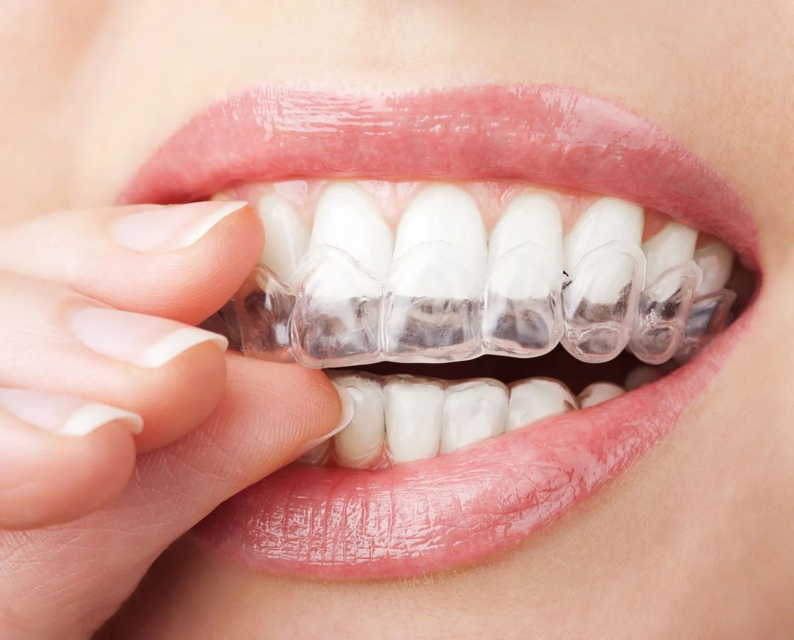 Tình trạng răng miệng khi niềng