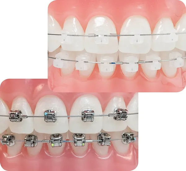 Độ tuổi niềng răng nào sẽ nhanh nhất?