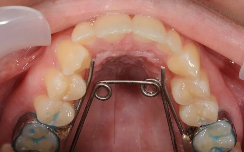 Cách giảm đau khi nong hàm và lưu ý khi thực hiện
