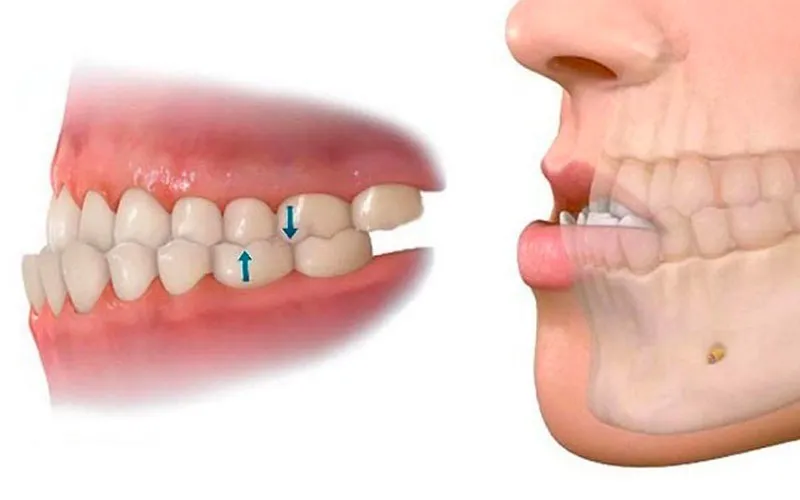 Người có cấu trúc vòm hàm hẹp