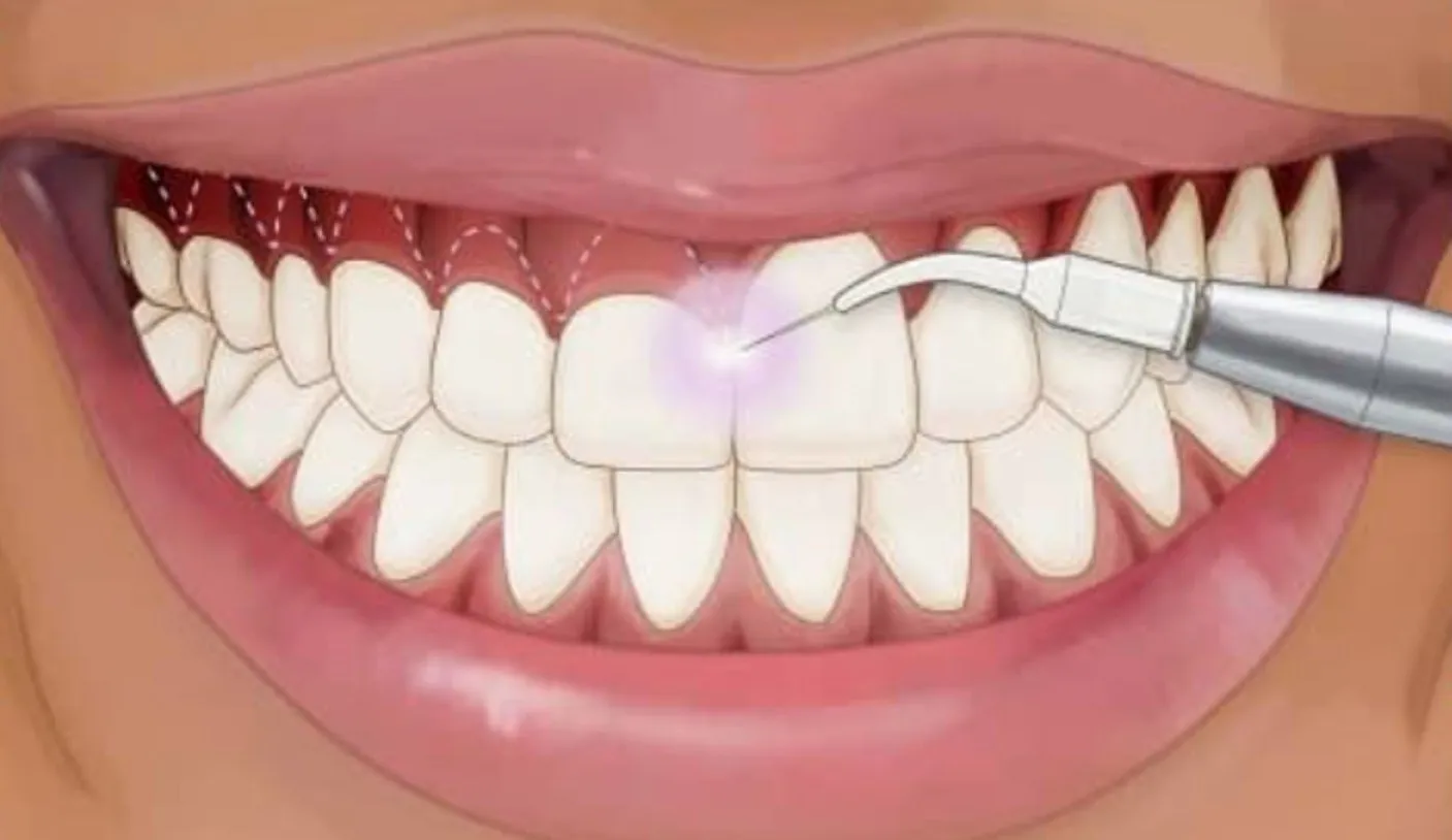Những trường hợp nào nên thực hiện cắt lợi