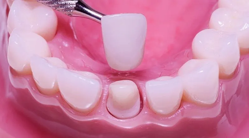 Bọc răng sứ cho răng bị mẻ