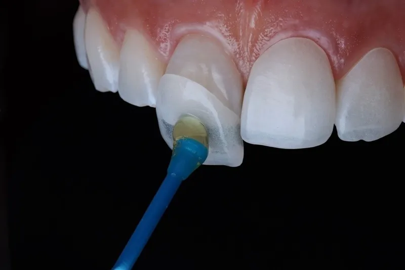 Răng cửa bị mẻ nên làm gì? - Dán Veener