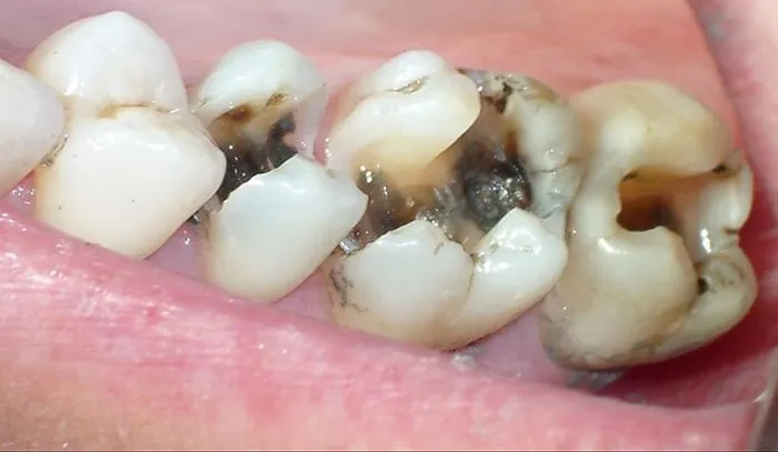Răng số 6 bị sâu có nên nhổ không?