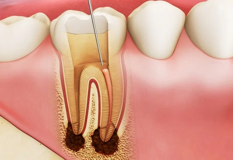 Răng bị viêm tủy nặng