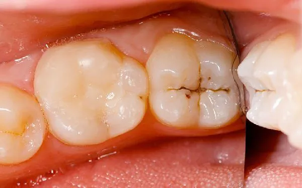 Cách điều trị răng số 7 bị sâu an toàn và hiệu quả