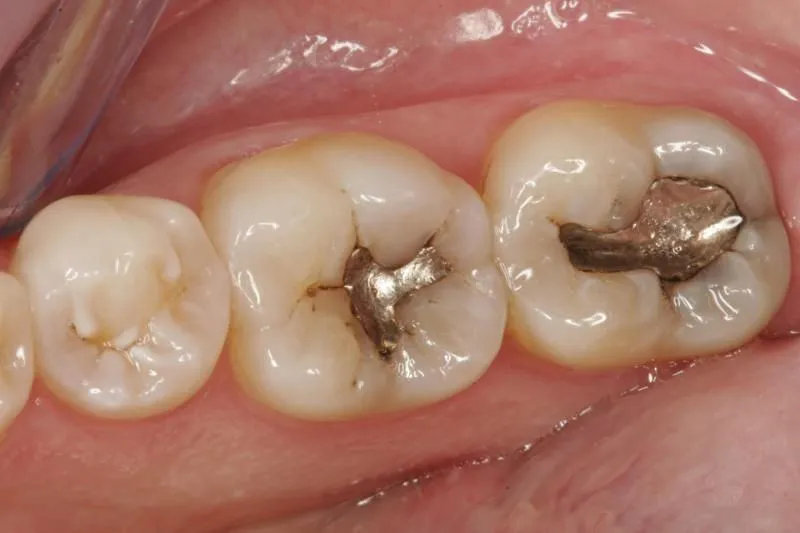 Răng số 7 bị sâu có nên nhổ không? Khi nào nên nhổ?
