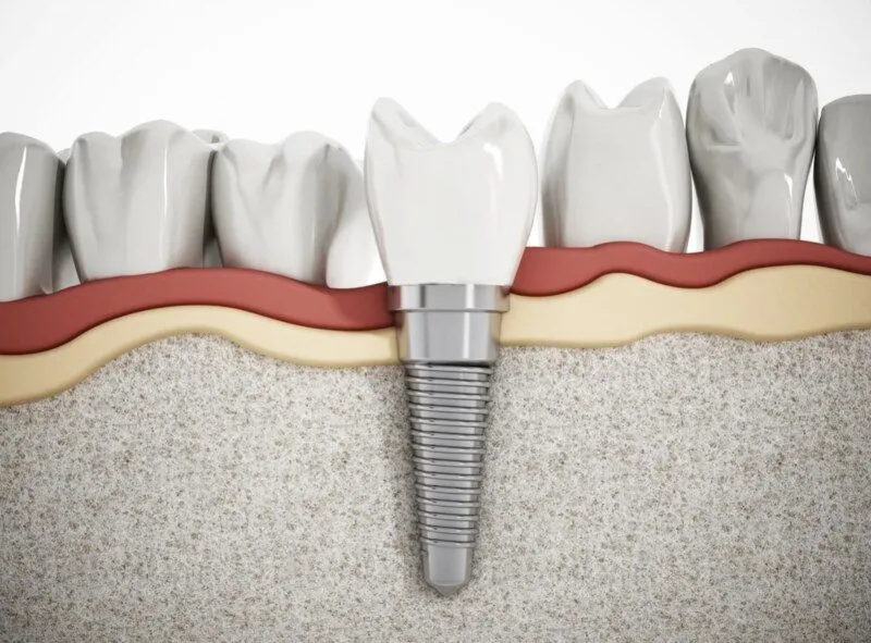 Khi nào cần trồng răng implant