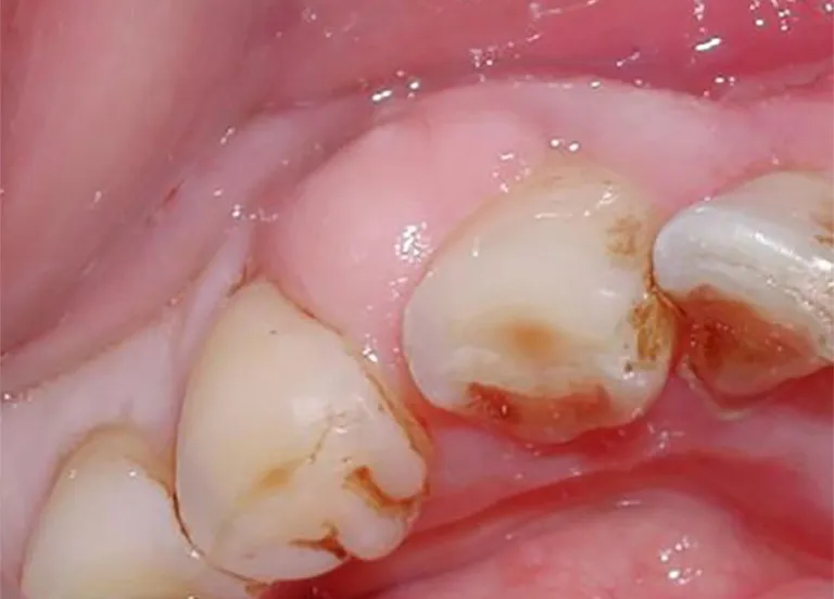 Hình ảnh viêm lợi trùm