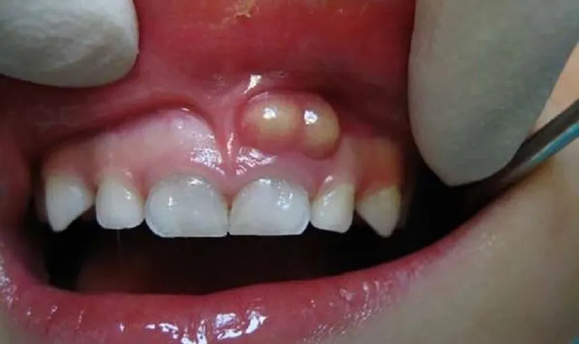 Viêm nha chu ở trẻ em là gì?