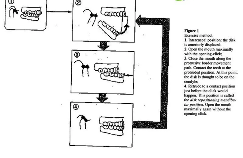 Cách chữa há miệng có tiếng kêu tại nhà - Bài tập thể dục hàm