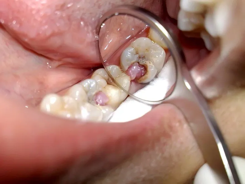 Khi nào cần điều trị tủy răng