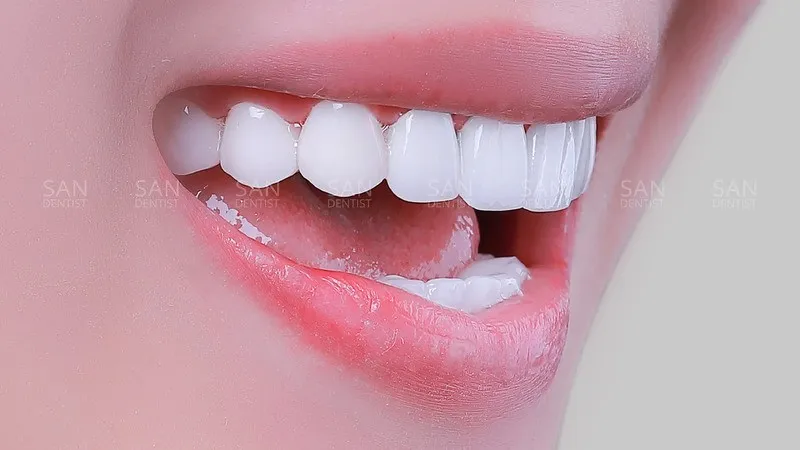 Dán sứ Veneer có tốt không - Ưu điểm
