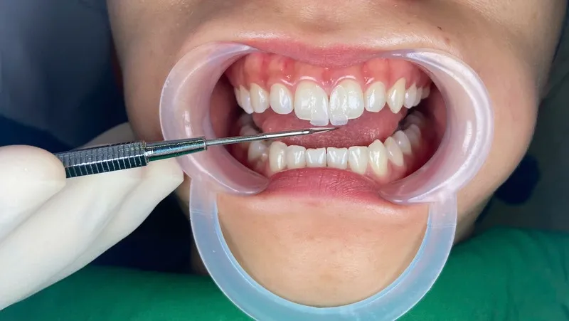 Quy trình dán răng sứ Veneer