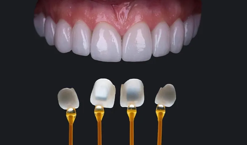Dán sứ Veneer là gì